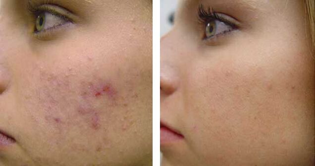 Before and after cryotherapy